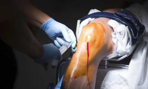 Diagnostic Arthroscopy