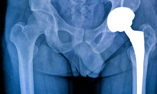 Total Hip Replacement