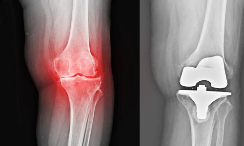 Total Knee Replacement